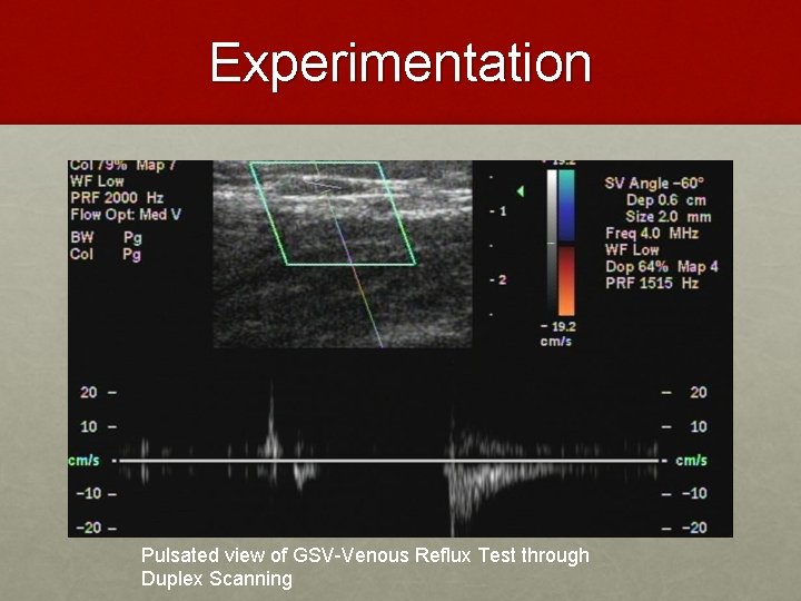 Experimentation Pulsated view of GSV-Venous Reflux Test through Duplex Scanning 