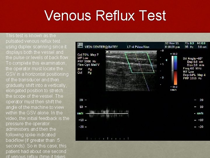 Venous Reflux Test This test is known as the pulsated venous reflux test using