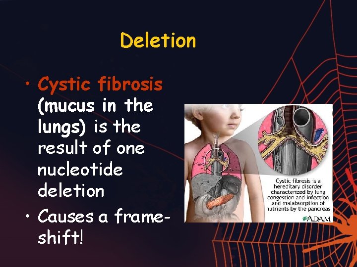 Deletion • Cystic fibrosis (mucus in the lungs) is the result of one nucleotide