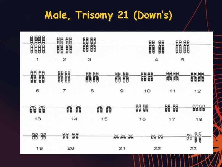 Male, Trisomy 21 (Down’s) 2 n = 47 32 