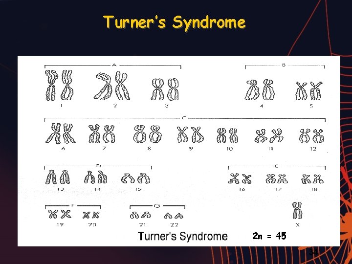 Turner’s Syndrome 2 n = 45 34 