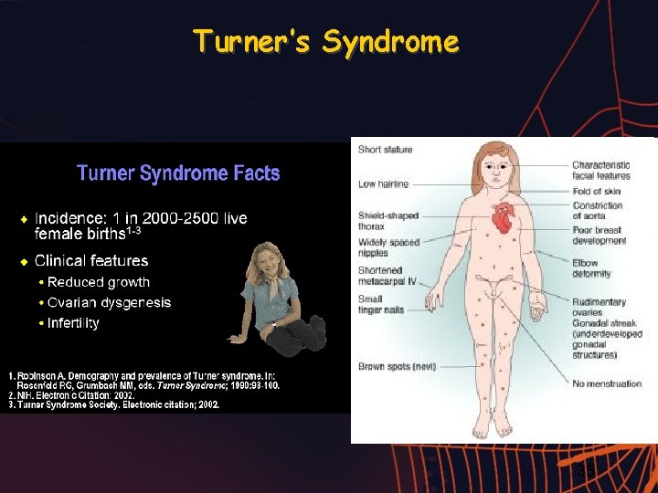 Turner’s Syndrome 35 