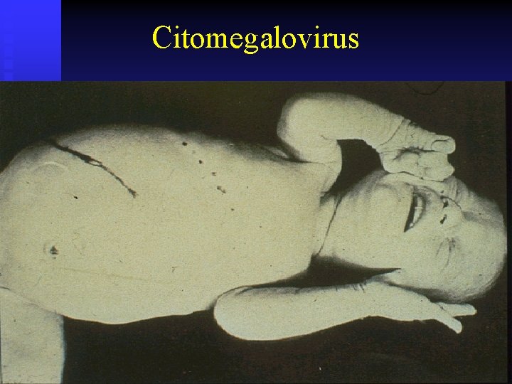 Citomegalovirus 