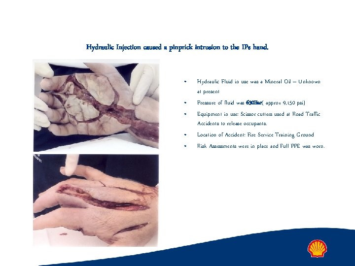 Hydraulic Injection caused a pinprick intrusion to the IPs hand. • • • Hydraulic