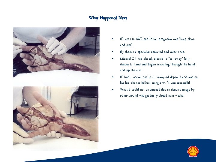 What Happened Next • • • IP went to A&E and initial prognosis was