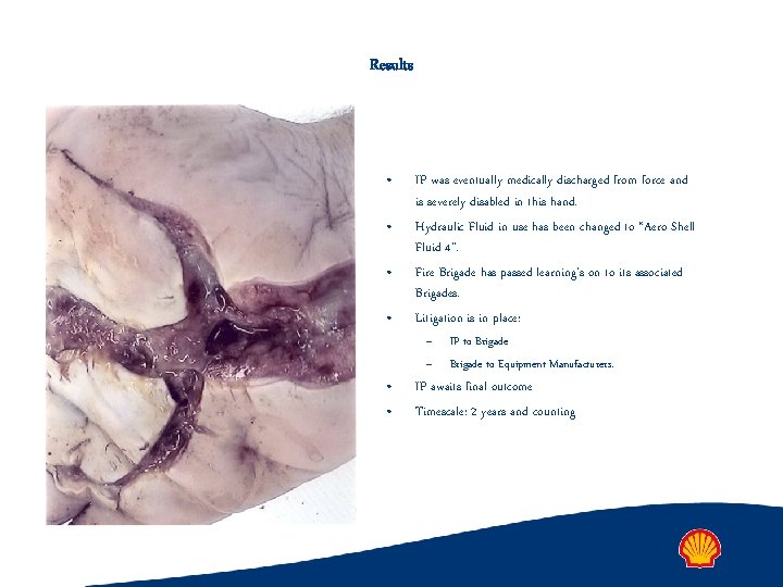 Results • • IP was eventually medically discharged from force and is severely disabled