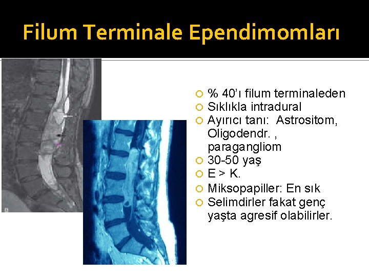 Filum Terminale Ependimomları % 40’ı filum terminaleden Sıklıkla intradural Ayırıcı tanı: Astrositom, Oligodendr. ,