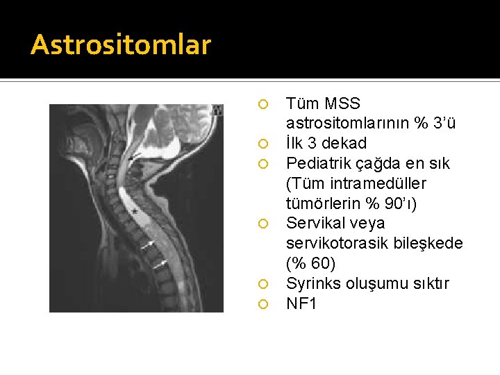 Astrositomlar Tüm MSS astrositomlarının % 3’ü İlk 3 dekad Pediatrik çağda en sık (Tüm