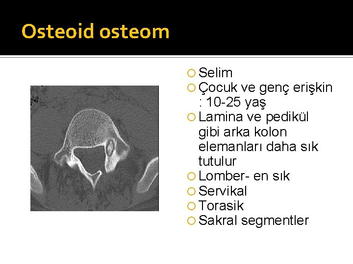 Osteoid osteom Selim Çocuk ve genç erişkin : 10 -25 yaş Lamina ve pedikül