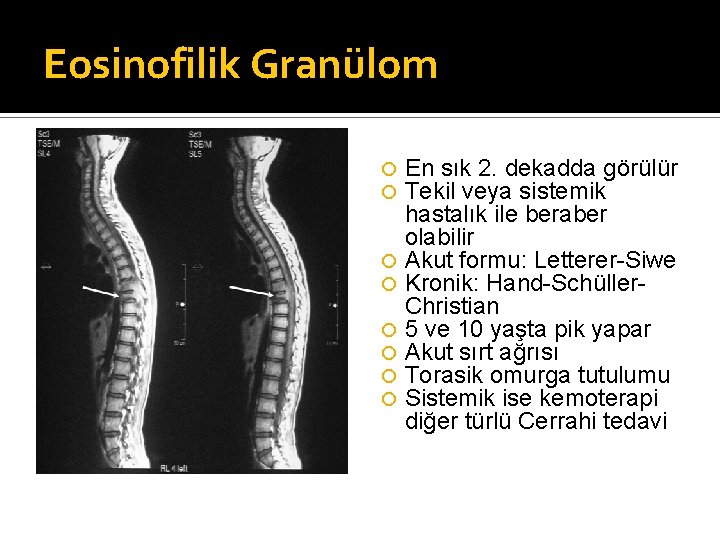 Eosinofilik Granülom En sık 2. dekadda görülür Tekil veya sistemik hastalık ile beraber olabilir