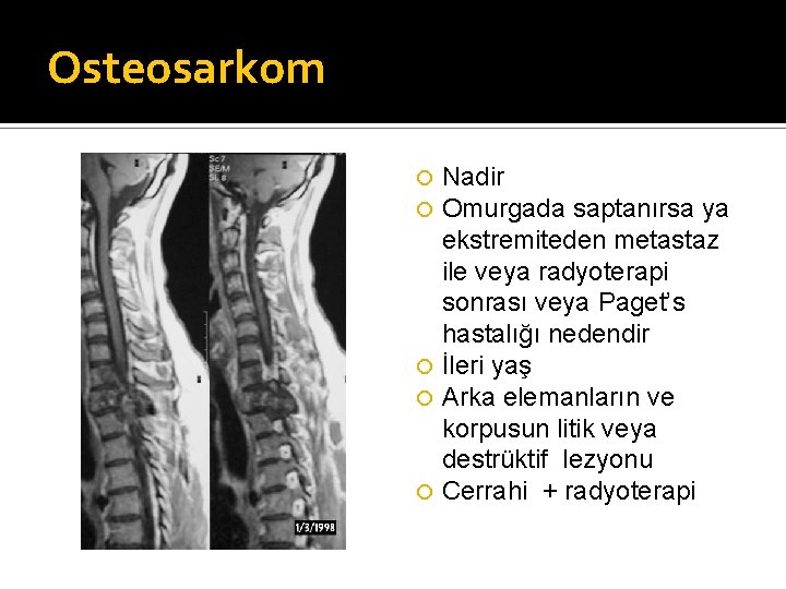 Osteosarkom Nadir Omurgada saptanırsa ya ekstremiteden metastaz ile veya radyoterapi sonrası veya Paget’s hastalığı