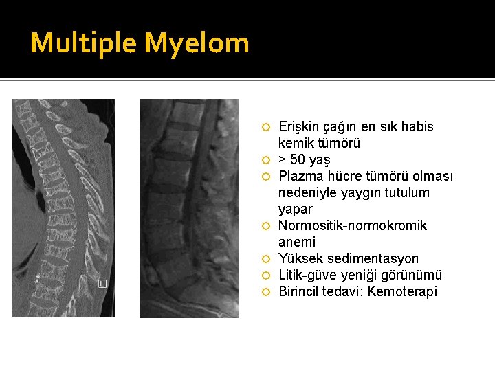 Multiple Myelom Erişkin çağın en sık habis kemik tümörü > 50 yaş Plazma hücre