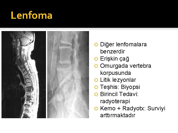 Lenfoma Diğer lenfomalara benzerdir Erişkin çağ Omurgada vertebra korpusunda Litik lezyonlar Teşhis: Biyopsi Birincil