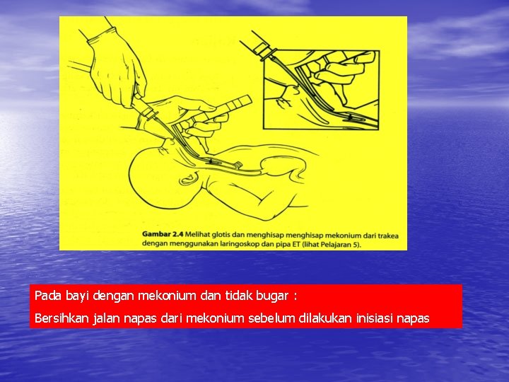 Pada bayi dengan mekonium dan tidak bugar : Bersihkan jalan napas dari mekonium sebelum Pada bayi dengan mekonium dan tidak bugar : Bersihkan jalan napas dari mekonium sebelum