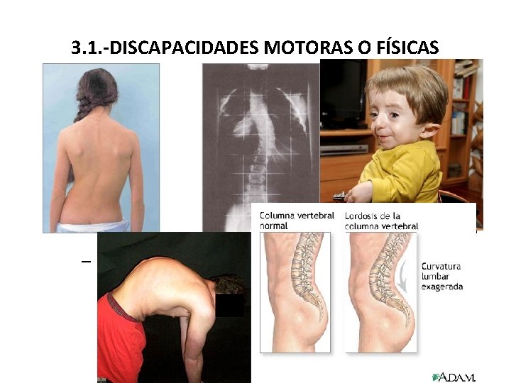 3. 1. -DISCAPACIDADES MOTORAS O FÍSICAS d) Problemas en huesos: cifosis, escoliosis, lordosis, osteogénesis