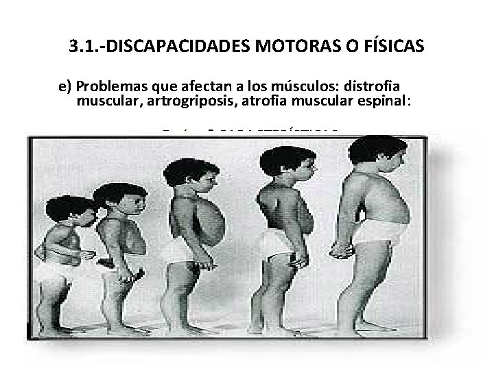 3. 1. -DISCAPACIDADES MOTORAS O FÍSICAS e) Problemas que afectan a los músculos: distrofia