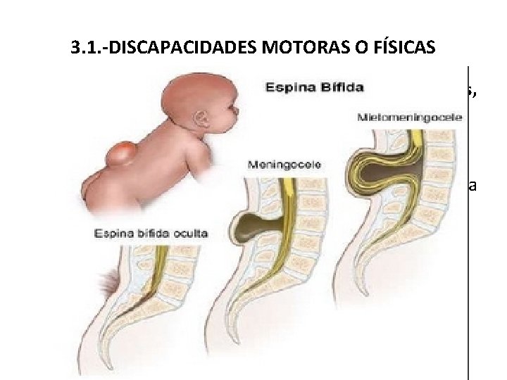 3. 1. -DISCAPACIDADES MOTORAS O FÍSICAS f) Problemas que afectan a la médula espinal: