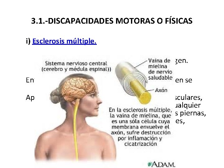 3. 1. -DISCAPACIDADES MOTORAS O FÍSICAS i) Esclerosis múltiple. ¿Qué es? CARACTERÍSTICAS. Origen. Enfermedad