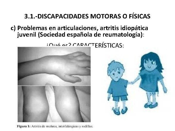 3. 1. -DISCAPACIDADES MOTORAS O FÍSICAS c) Problemas en articulaciones, artritis idiopática juvenil (Sociedad