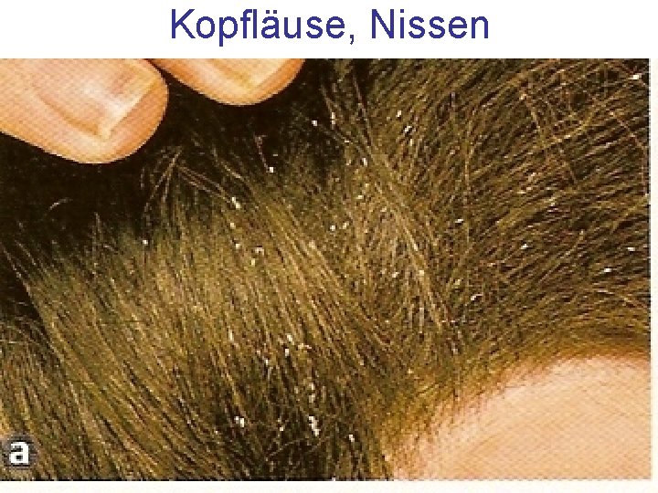 Kopfläuse, Nissen 