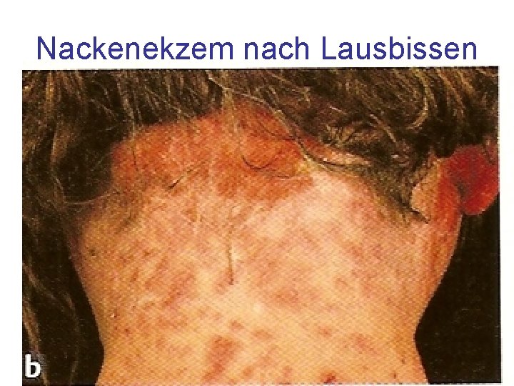 Nackenekzem nach Lausbissen 