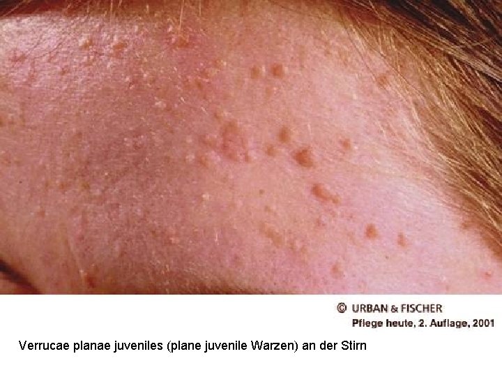 Verrucae planae juveniles (plane juvenile Warzen) an der Stirn 