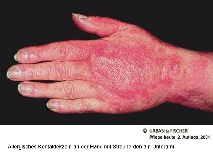 Allergisches Kontaktekzem an der Hand mit Streuherden am Unterarm 