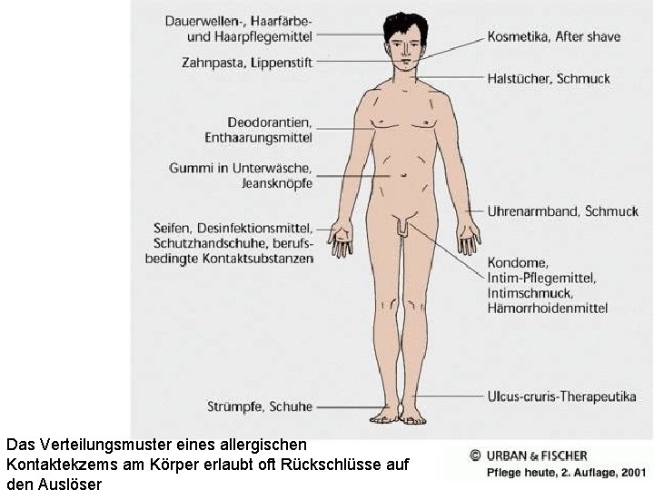 Das Verteilungsmuster eines allergischen Kontaktekzems am Körper erlaubt oft Rückschlüsse auf den Auslöser 