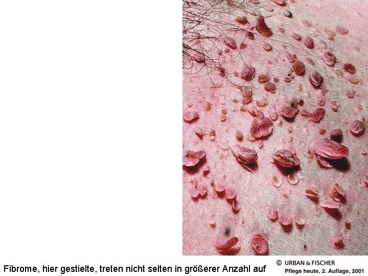 Fibrome, hier gestielte, treten nicht selten in größerer Anzahl auf 