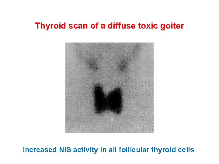 Thyroid scan of a diffuse toxic goiter Increased NIS activity in all follicular thyroid Thyroid scan of a diffuse toxic goiter Increased NIS activity in all follicular thyroid