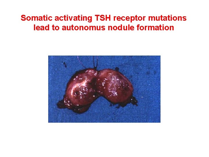 Somatic activating TSH receptor mutations lead to autonomus nodule formation Somatic activating TSH receptor mutations lead to autonomus nodule formation