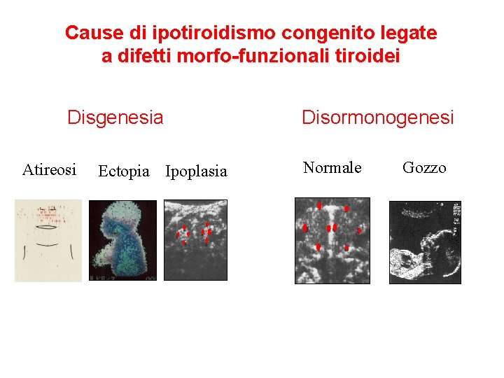 Cause di ipotiroidismo congenito legate a difetti morfo-funzionali tiroidei Disgenesia Atireosi Ectopia Ipoplasia Disormonogenesi Cause di ipotiroidismo congenito legate a difetti morfo-funzionali tiroidei Disgenesia Atireosi Ectopia Ipoplasia Disormonogenesi