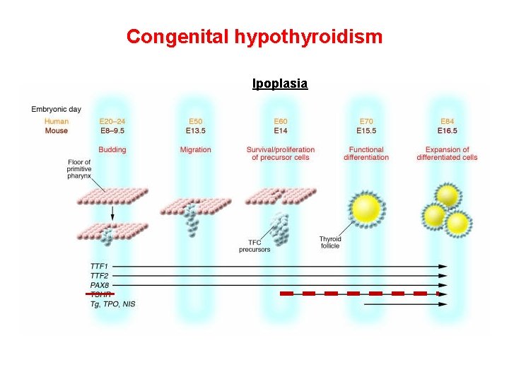 Congenital hypothyroidism Ipoplasia Congenital hypothyroidism Ipoplasia