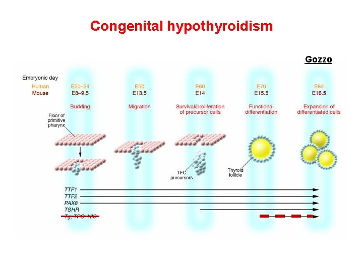 Congenital hypothyroidism Gozzo Congenital hypothyroidism Gozzo