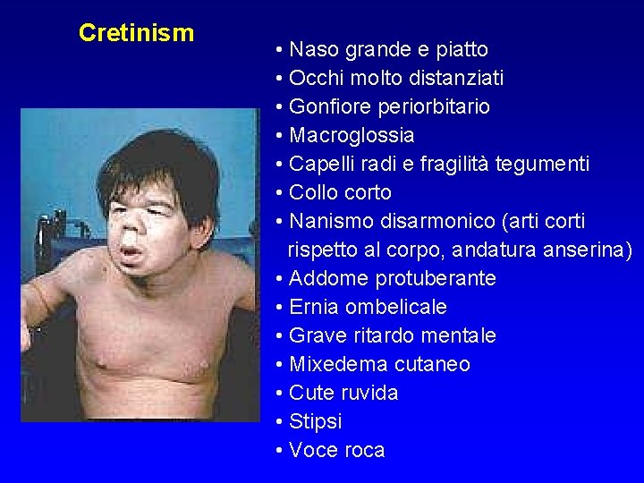 Cretinism • Naso grande e piatto • Occhi molto distanziati • Gonfiore periorbitario • Cretinism • Naso grande e piatto • Occhi molto distanziati • Gonfiore periorbitario •
