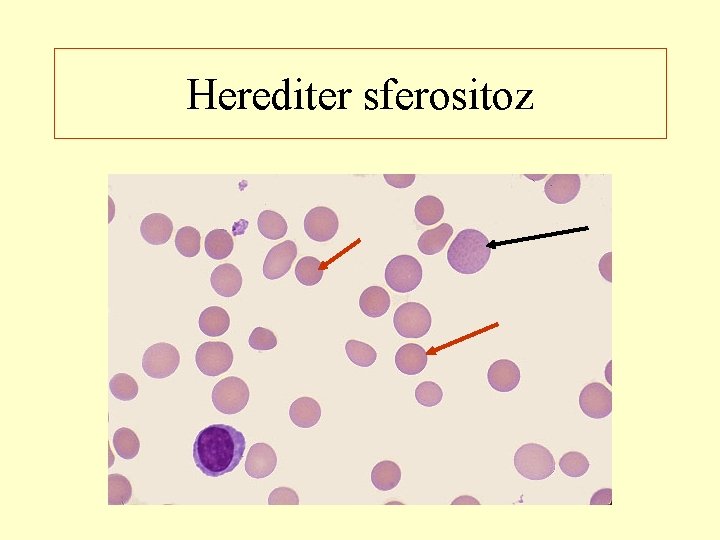 Herediter sferositoz 