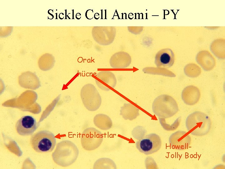 Sickle Cell Anemi – PY Orak hücre Eritroblastlar Howell. Jolly Body 