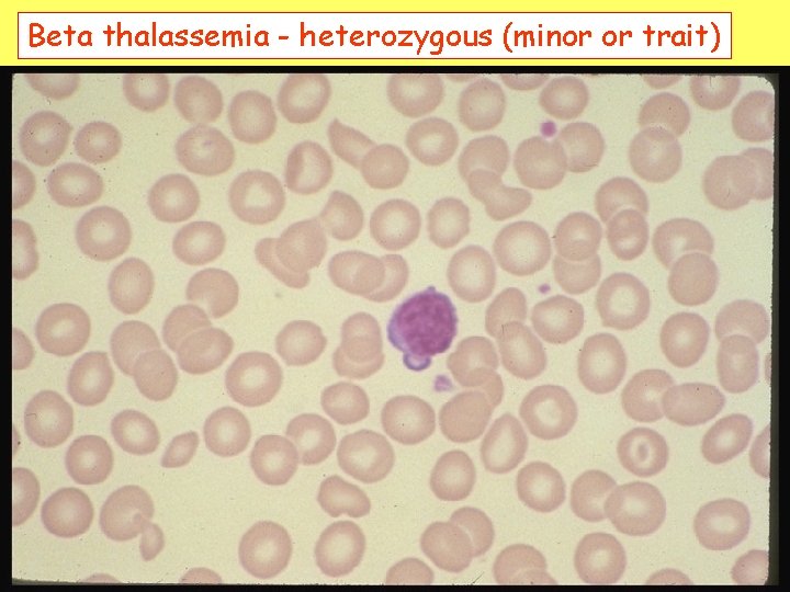 Beta thalassemia - heterozygous (minor or trait) 