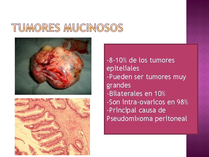 -8 -10% de los tumores epiteliales -Pueden ser tumores muy grandes -Bilaterales en 10%
