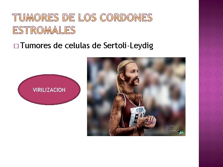 � Tumores de celulas de Sertoli-Leydig VIRILIZACION 