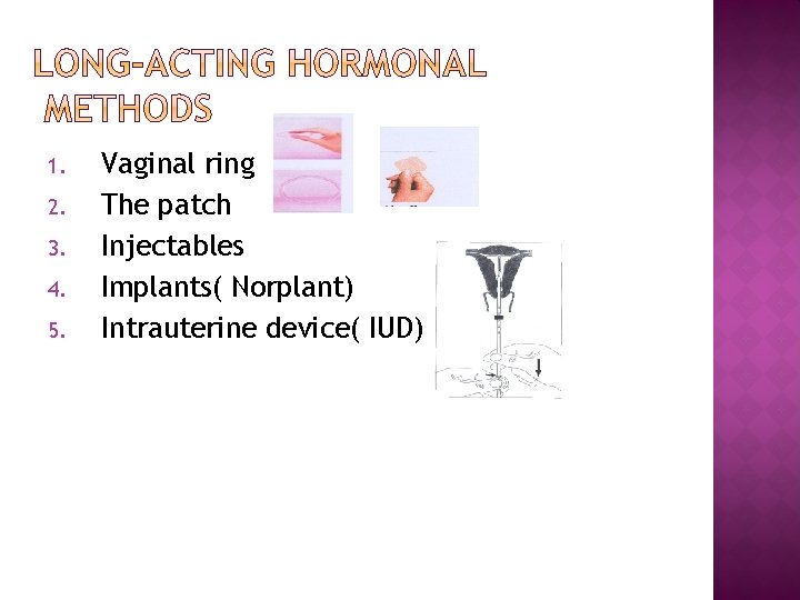 1. 2. 3. 4. 5. Vaginal ring The patch Injectables Implants( Norplant) Intrauterine device(