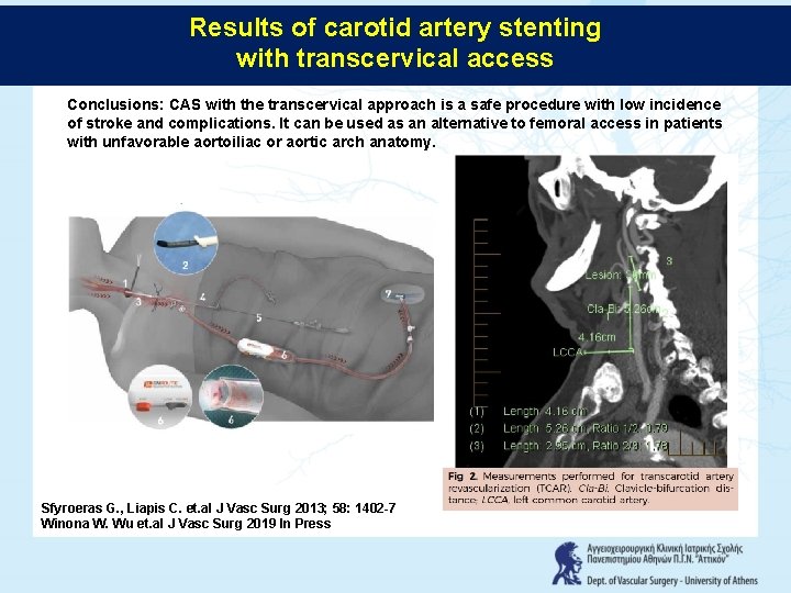 Results of carotid artery stenting with transcervical access Conclusions: CAS with the transcervical approach