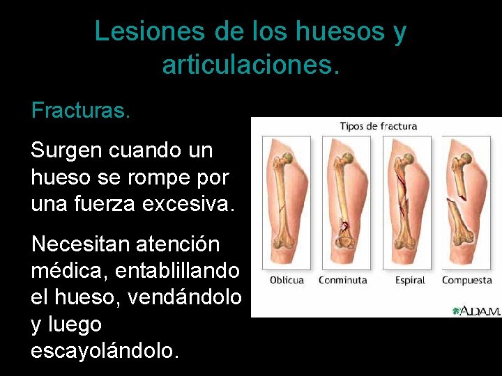 Lesiones de los huesos y articulaciones. Fracturas. Surgen cuando un hueso se rompe por