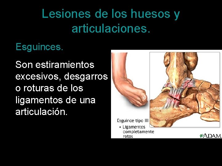 Lesiones de los huesos y articulaciones. Esguinces. Son estiramientos excesivos, desgarros o roturas de