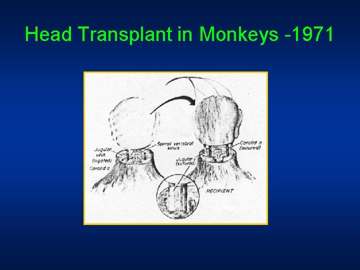 Head Transplant in Monkeys -1971 Head Transplant in Monkeys -1971