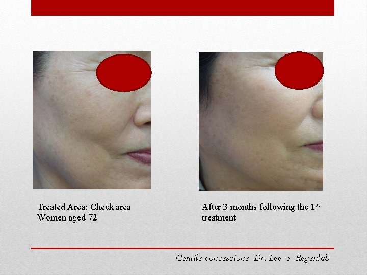 Treated Area: Cheek area Women aged 72 After 3 months following the 1 st