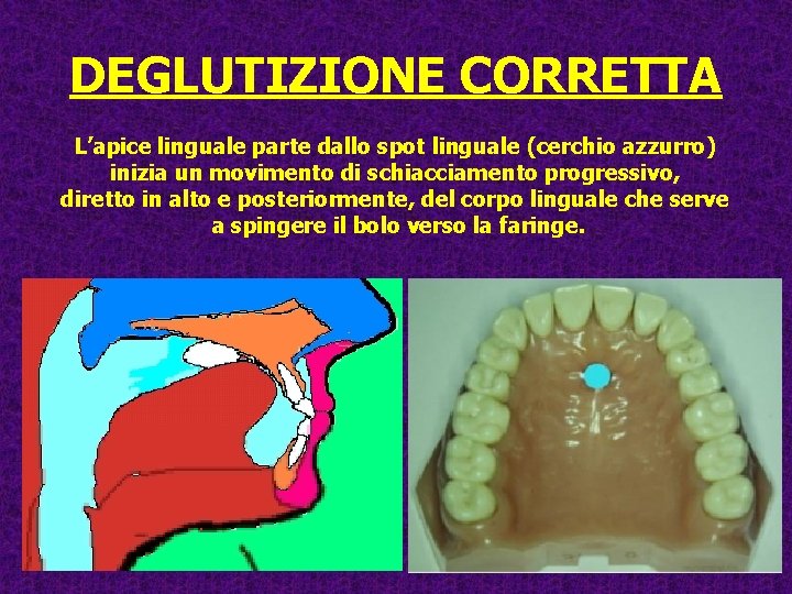 DEGLUTIZIONE CORRETTA L’apice linguale parte dallo spot linguale (cerchio azzurro) inizia un movimento di DEGLUTIZIONE CORRETTA L’apice linguale parte dallo spot linguale (cerchio azzurro) inizia un movimento di