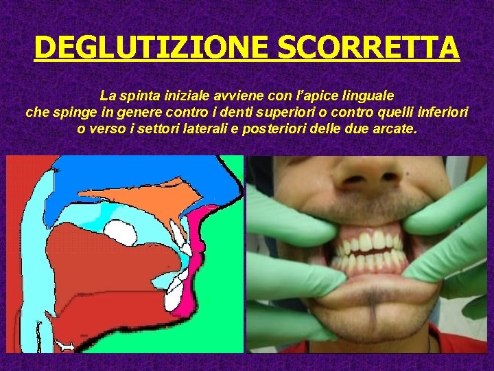 DEGLUTIZIONE SCORRETTA La spinta iniziale avviene con l’apice linguale che spinge in genere contro DEGLUTIZIONE SCORRETTA La spinta iniziale avviene con l’apice linguale che spinge in genere contro