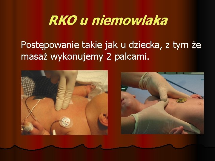 RKO u niemowlaka Postępowanie takie jak u dziecka, z tym że masaż wykonujemy 2