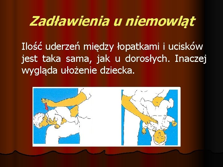 Zadławienia u niemowląt Ilość uderzeń między łopatkami i ucisków jest taka sama, jak u